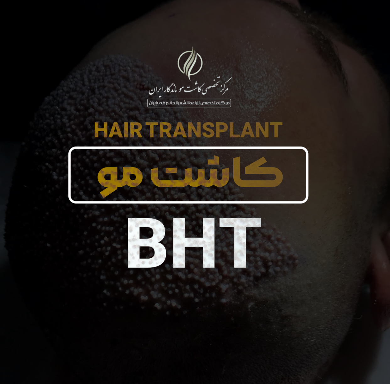 کاشت مو به روش BHT