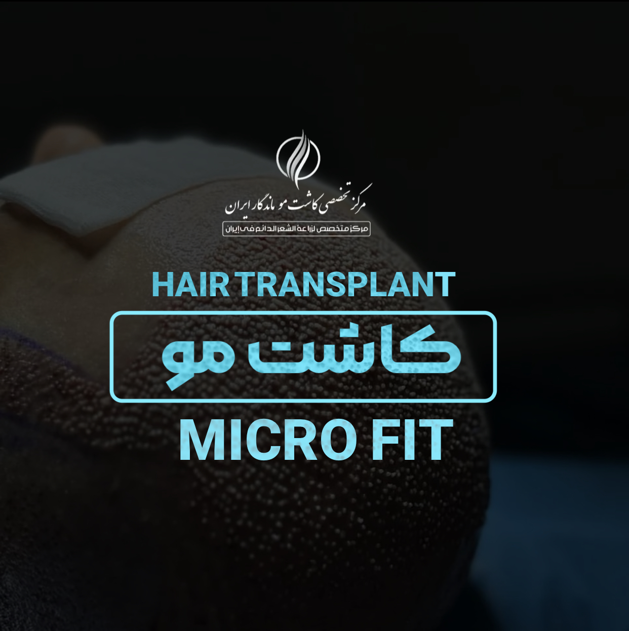 کاشت مو به روش MICRO FIT